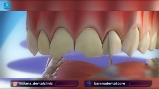 چگونگی اجرای لمینت دندان رفع افتادگی پلک
