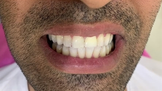 هوم بلیچینگ چیست