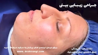 بهترین دکتر عمل بینی گوشتی در تهران