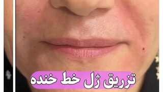 تزریق فیلر خط خنده لیفت پیشانی