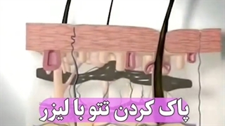 پاک کردن تاتو