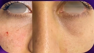 تزریق ژل زیر چشم