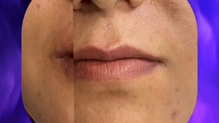 تزریق ژل لب