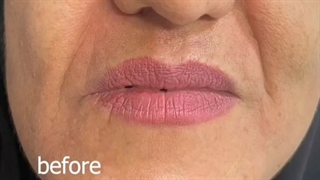 تزریق ژل خط خنده