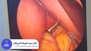 نمای بزرگی کبد و کبد چرب در بیماران حین عمل اسلیو