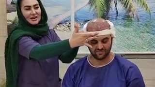 کاشت مو با بانک ضعیف