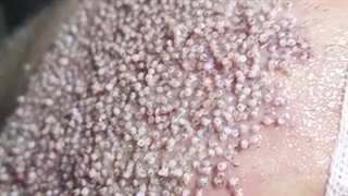 کاشت مو با بانک ضعیف