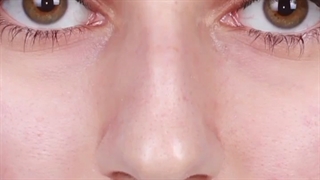 جراحی پرچالش بینی استخوانی با قوز زیاد