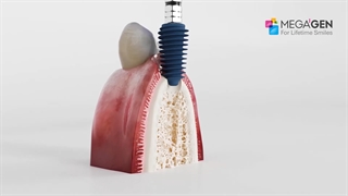 هزینه ایمپلنت دندان