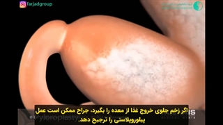 زخم معده چگونه ایجاد می شود