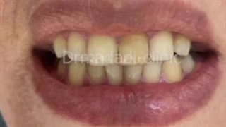 شش واحد لمینیت سرامیکی