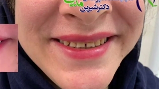 هشت واحد لمینت سرامیکی ایمکس