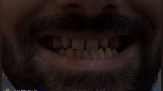 درمان ترکیبی لمینت سرامیکی ایمکس و ایمپلنت