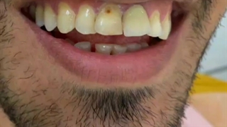 هشت واحد لمینت سرامیکی ایمکس