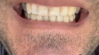 هشت واحد لمینت سرامیکی ایمکس