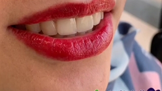 ترکیب روکش تمام سرامیک و لمینت های سرامیکی