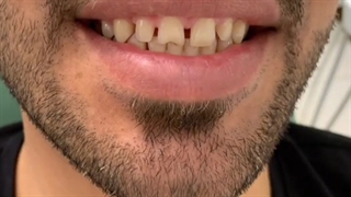 8  واحد ونیر کامپوزیت فک بالا