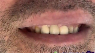 درمان ترکیبی روکش تمام سرامیک و لمینت سرامیکی ایمکس