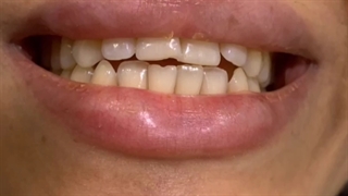 18واحد لمینت سرامیکی ایمکس