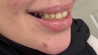 درمان ترکیبی روکش تمام سرامیک و لمینت سرامیکی ایمکس