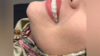 12 واحد لمینت سرامیکی ایمکس