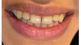 هوم بلیچینگ