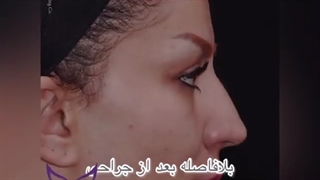 پروتز زیبایی