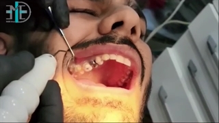 کاربرد پلاسما در حیطه ی دندانپزشکی