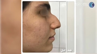 جراحی رینوپلاستی بینی با انحراف شدید