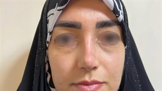 جراحی زیبایی بینی