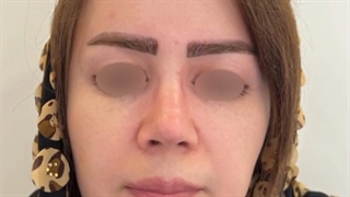 جراحی زیبایی بینی