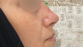 نمونه قبل و بعد از رینوپلاستی زیباجوی عزیزمون