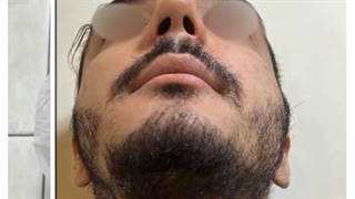 رفع قوز بینی و افتادگی نوک بینی