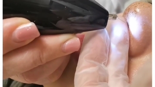 کوچک کردن بینی با پلکسر