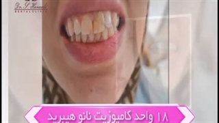 انجام ۱۸ واحد کامپوزیت نانو هیبرید