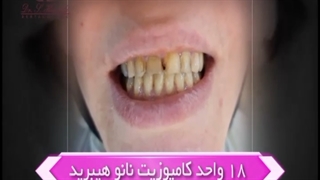 انجام ۱۸ واحد کامپوزیت نانو هیبرید برای زیباجوی عزیز ما