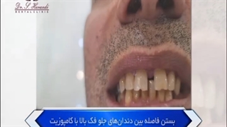 بستن فاصله بین دندان های جلویی فک بالا با کامپوزیت