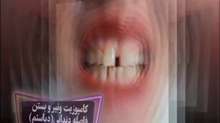 انجام کامپوزیت ونیر و بستن فاصله دندانی(دیاستم)