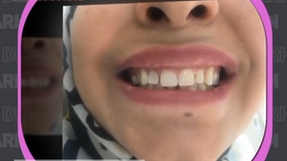 ٨ واحد کامپوزیت ونیر رنگ بلیچ نانو سرام
