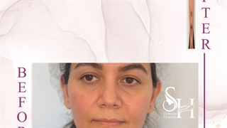 تزریق فیلر در ناحیه شیار اشکی