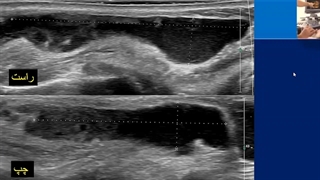 نقش سونوگرافی در تشخیص ژل های تزریقی