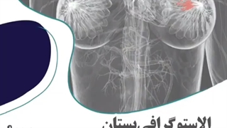 الاستوگرافی پستان، چه مواردی را تشخیص می دهد؟