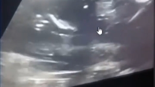 تاحالا دیدید نشه جنسیت جنینو تشخیص داد