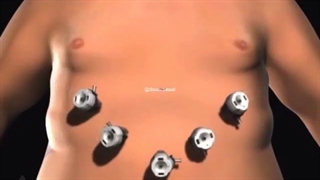 عمل کوچک کردن معده