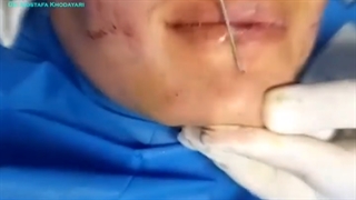 تزریق چربی به صورت