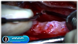 چگونگی جراحی ملانوم تمپورال