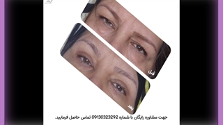 افتادگی پلک