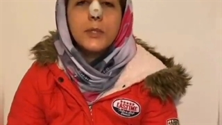 رضایت زیبا جوی عزیز بعد از جراحی زیبایی بینی