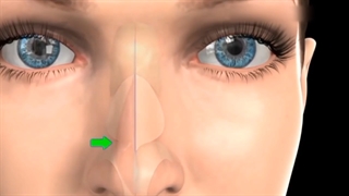 سپتوپلاستی