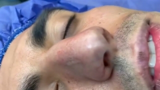 عمل سپتوراینوپلاستی